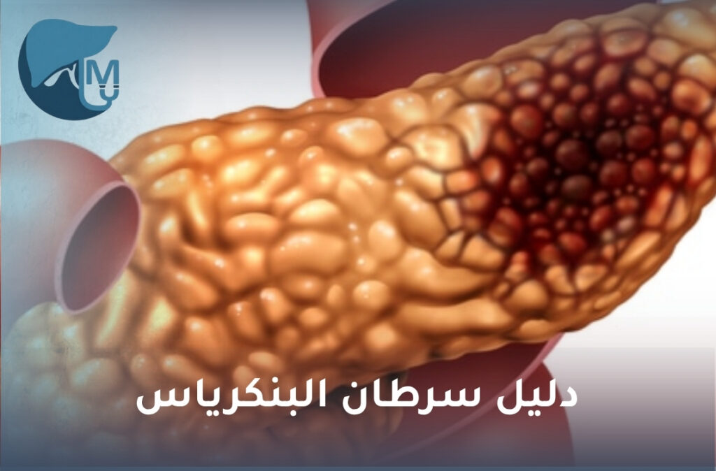 سرطان البنكرياس
