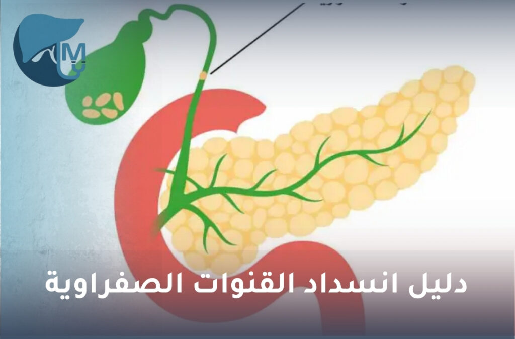 انسداد القنوات الصفراوية