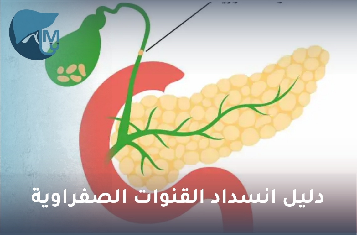 دليل انسداد القنوات الصفراوية: الأسباب والأعراض وطرق العلاج