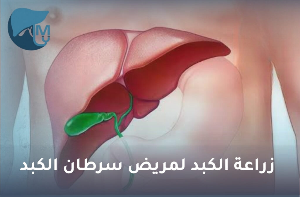 زراعة الكبد لمريض سرطان الكبد