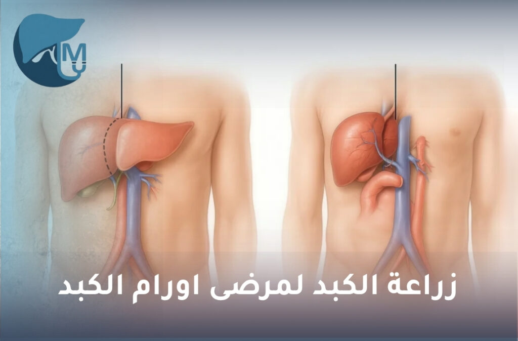 زراعة الكبد لمرضى اورام الكبد
