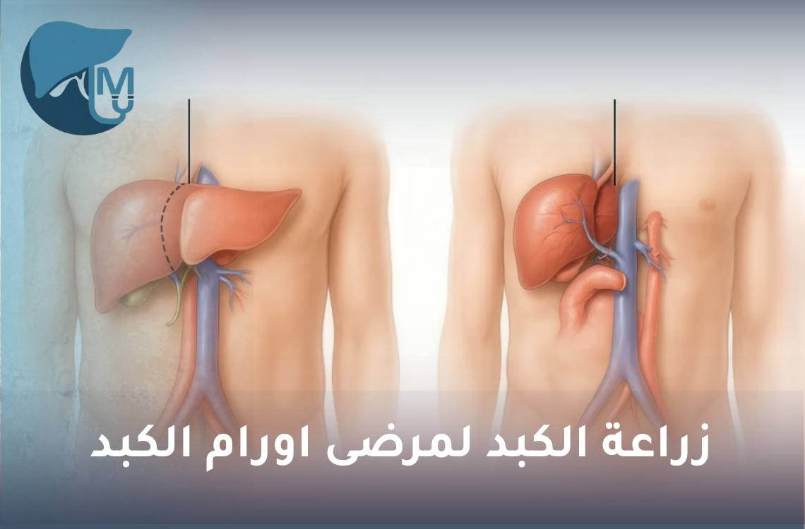 زراعة الكبد لمرضى أورام الكبد.. متى تكون الخيار العلاجي المناسب؟