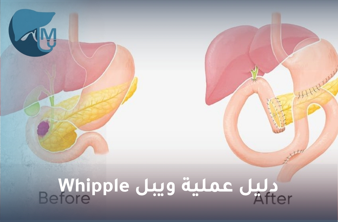 دليل عملية ويبل Whipple: الخطوات ونسبة النجاح والتعافي والتكلفة
