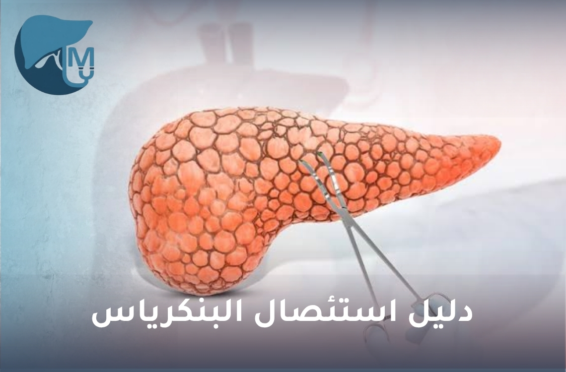 دليل استئصال البنكرياس: الأنواع والأسباب والمضاعفات والحياة بعد العملية