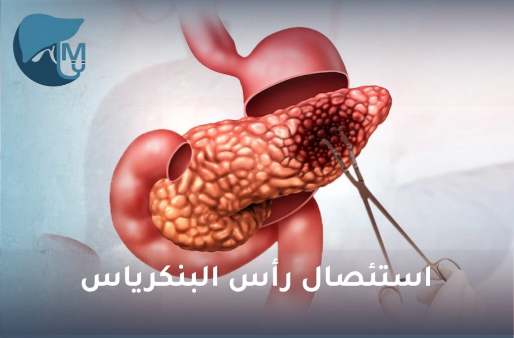 استئصال رأس البنكرياس