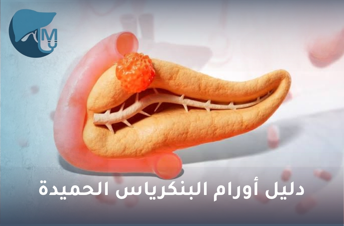 دليل أورام البنكرياس الحميدة: الأنواع والأعراض والعلاج