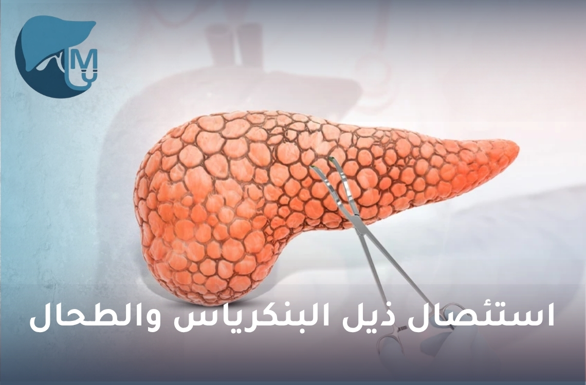 استئصال ذيل البنكرياس والطحال.. متى تصبح الجراحة ضرورية وكيف تسير رحلة التعافي؟