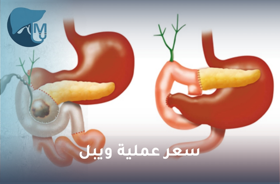 سعر عملية ويبل.. ما العوامل التي تحدد تكلفة الجراحة؟