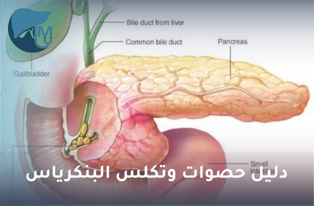 حصوات وتكلس البنكرياس