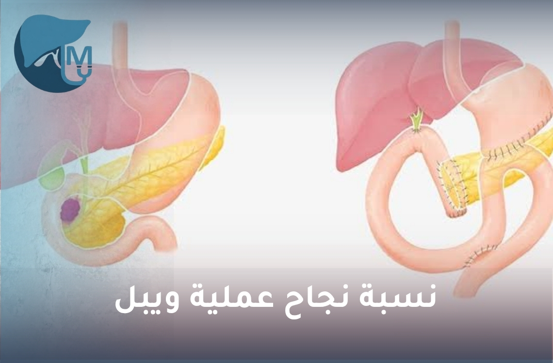 نسبة نجاح عملية ويبل.. العوامل التي تؤثر في نتائج الجراحة