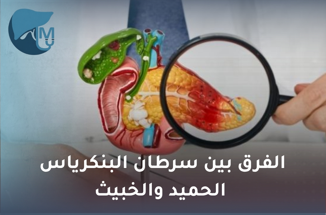الفرق بين سرطان البنكرياس الحميد والخبيث.. فهم صحيح لطبيعة أورام البنكرياس