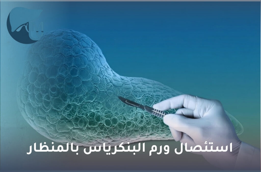 استئصال ورم البنكرياس بالمنظار
