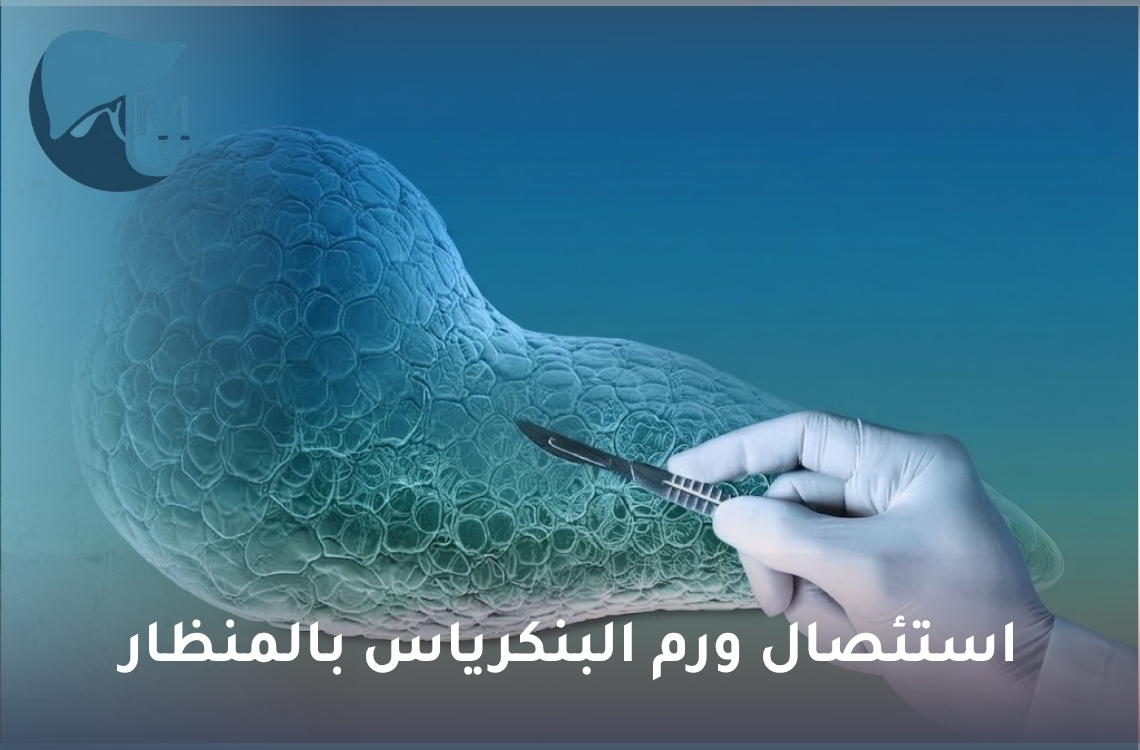 استئصال ورم البنكرياس بالمنظار