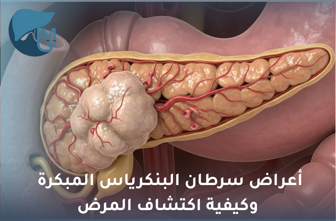 أعراض سرطان البنكرياس المبكرة وكيفية اكتشاف المرض