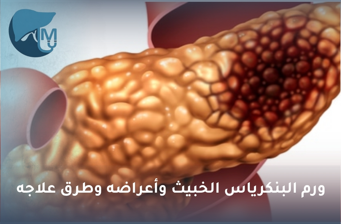 ورم البنكرياس الخبيث وأعراضه وطرق علاجه