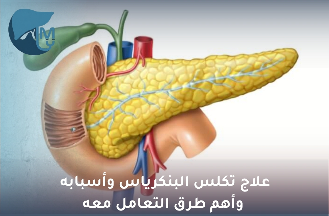 علاج تكلس البنكرياس وأسبابه وأهم طرق التعامل معه