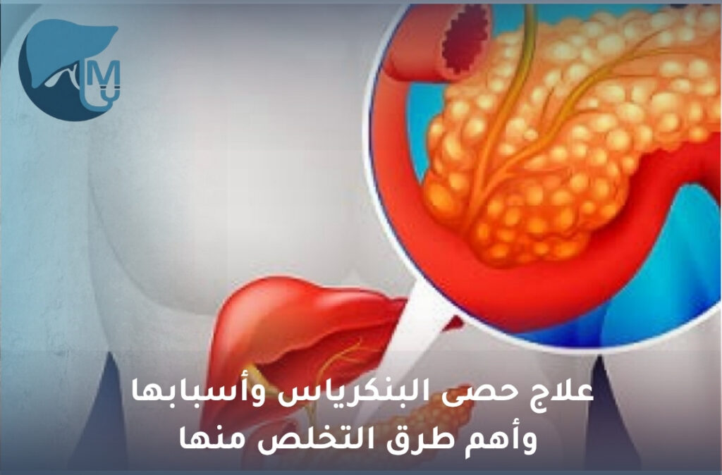 علاج حصى البنكرياس