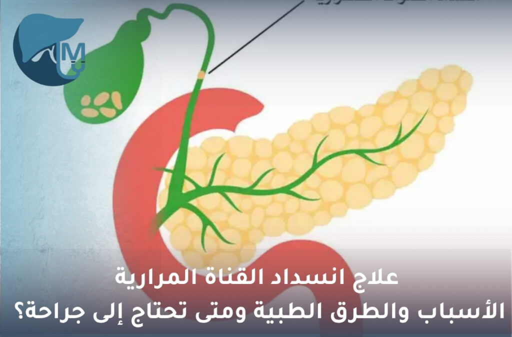 علاج انسداد القناة المرارية