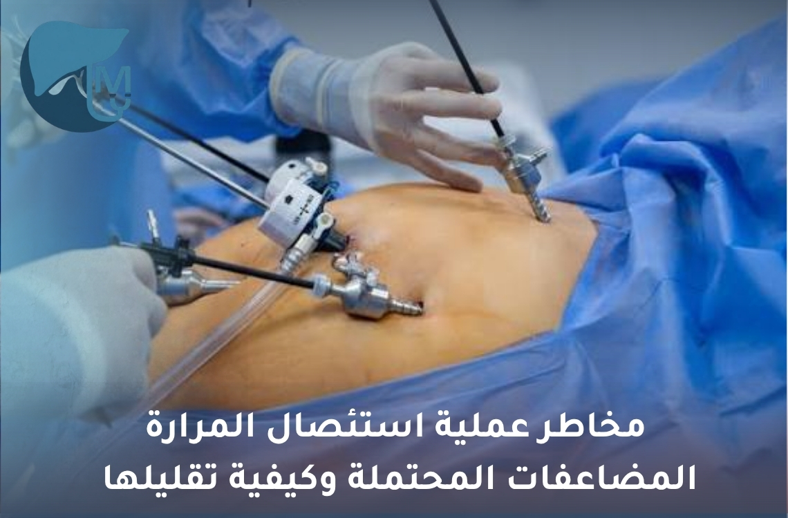 مخاطر عملية استئصال المرارة: المضاعفات المحتملة وكيفية تقليلها